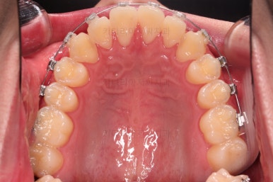 부산주걱턱교정