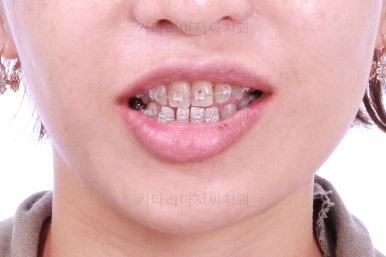 부산연산동교정치과