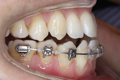 부산비수술교정