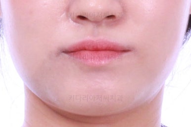 부산치아교정잘하는곳