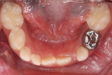 부산어린이치아교정