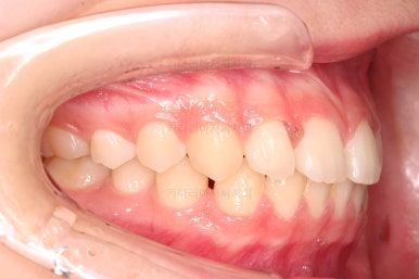 부산앞니벌어짐교정