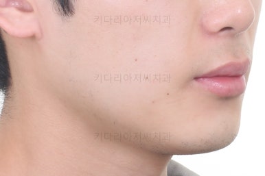 연산동치아교정