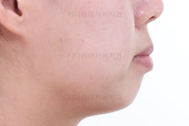 부산치아교정잘하는치과