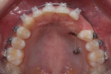 부산매복치아교정