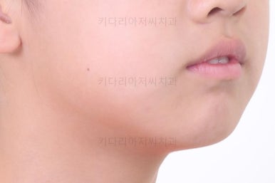 부산토끼치아교정