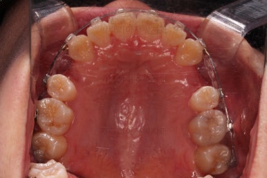 부산치아교정잘하는치과