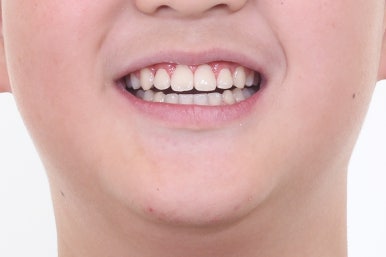 부산비발치교정