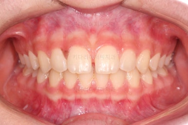 부산앞니벌어짐교정