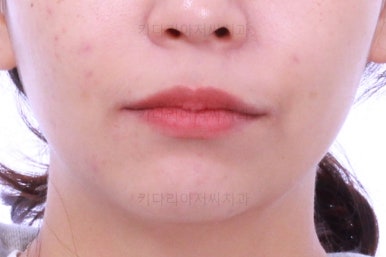 부산사랑니교정