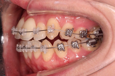 부산치아교정잘하는곳