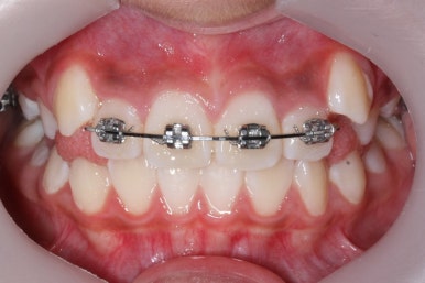 연산동덧니교정