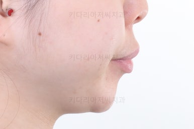 부산연산동교정치과