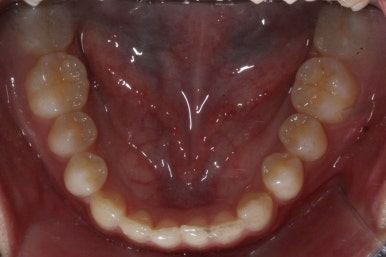 부산매복치아교정