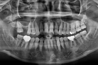 부산치아교정비용