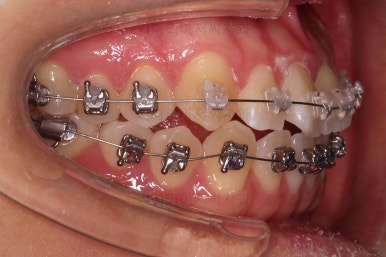 부산치아교정잘하는곳