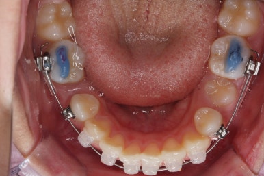 부산치아교정잘하는곳