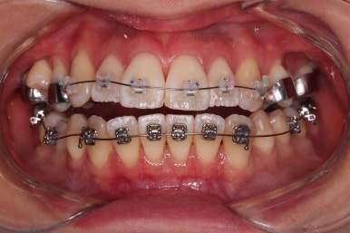 부산치아교정잘하는치과