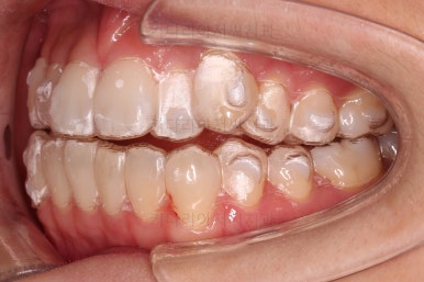 부산인비절라인