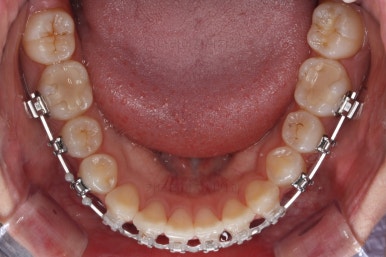 부산치아교정잘하는곳