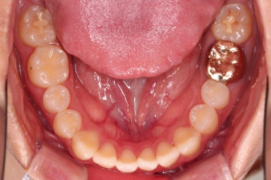 부산치아교정잘하는곳