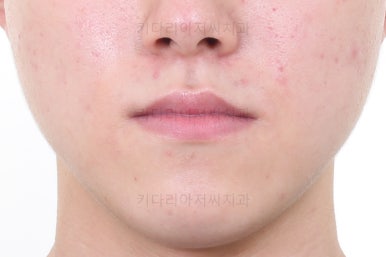 부산주걱턱교정