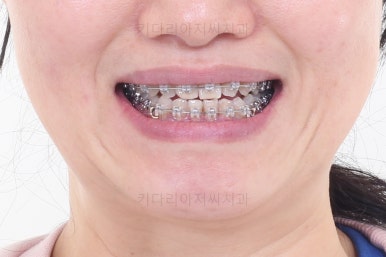 부산치아교정잘하는곳
