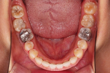 부산구순구개열