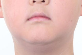 부산비발치교정
