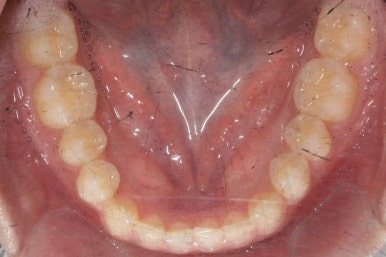 부산매복치아교정