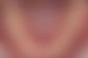 부산매복치아교정