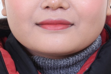 부산사각턱보톡스