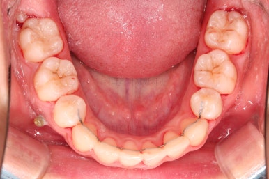 부산클리피씨교정