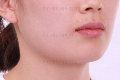 부산앞니부분교정