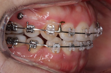 부산연산동교정치과