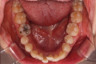 부산비발치교정