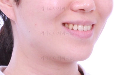 부산치아교정잘하는곳