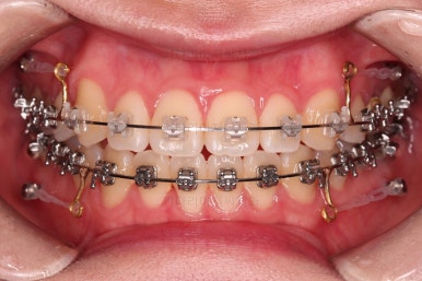 부산치아교정잘하는곳