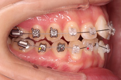 부산비발치교정