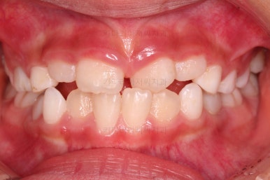 부산어린이반대교합