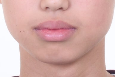 부산치아교정전문의
