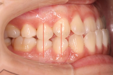 부산치아교정추천