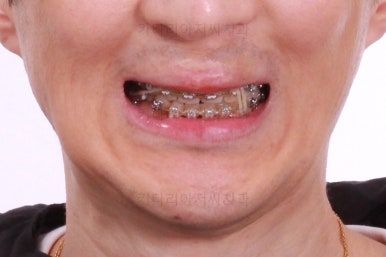 부산구순구개열교정