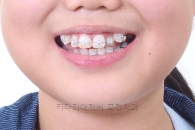 연산동치아교정