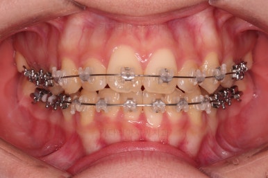 부산비발치교정