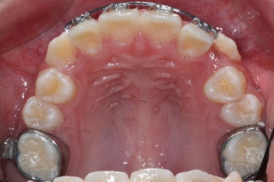 연산동덧니교정