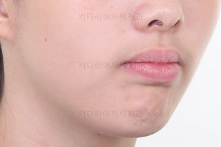 부산투명교정