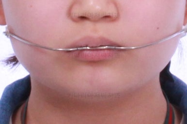부산어린이치아교정