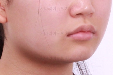 부산어린이치아교정