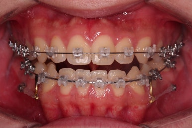 부산주걱턱교정